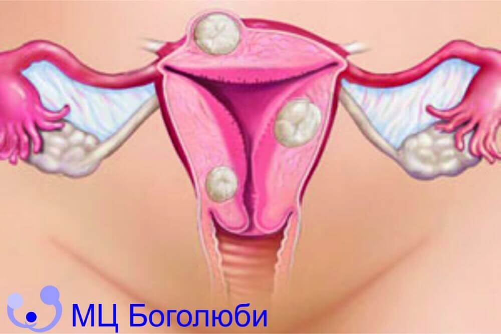 Хірургія фіброміоми матки, фото