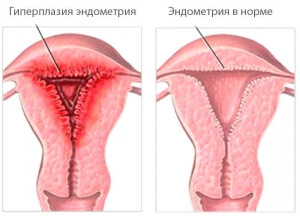 Endometrial hyperplasia, фото