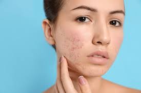 Cystic acne: how to recognize and help?, фото